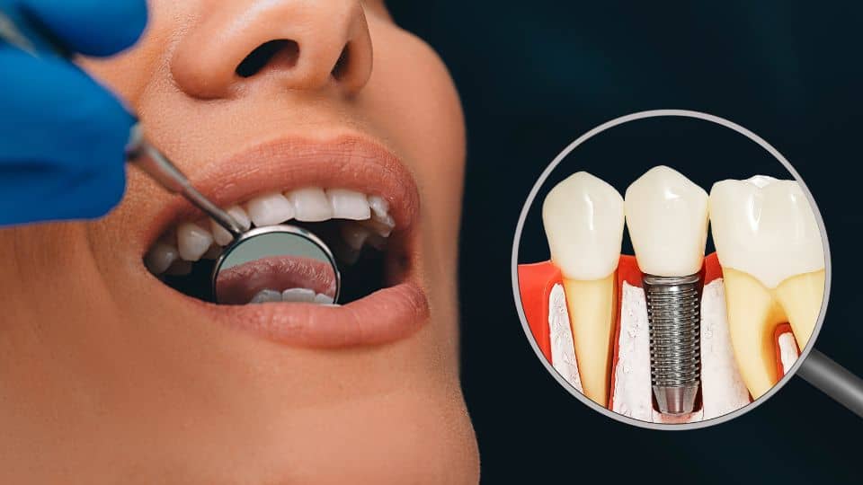 מה חשוב לדעת לפני השתלת שיניים?